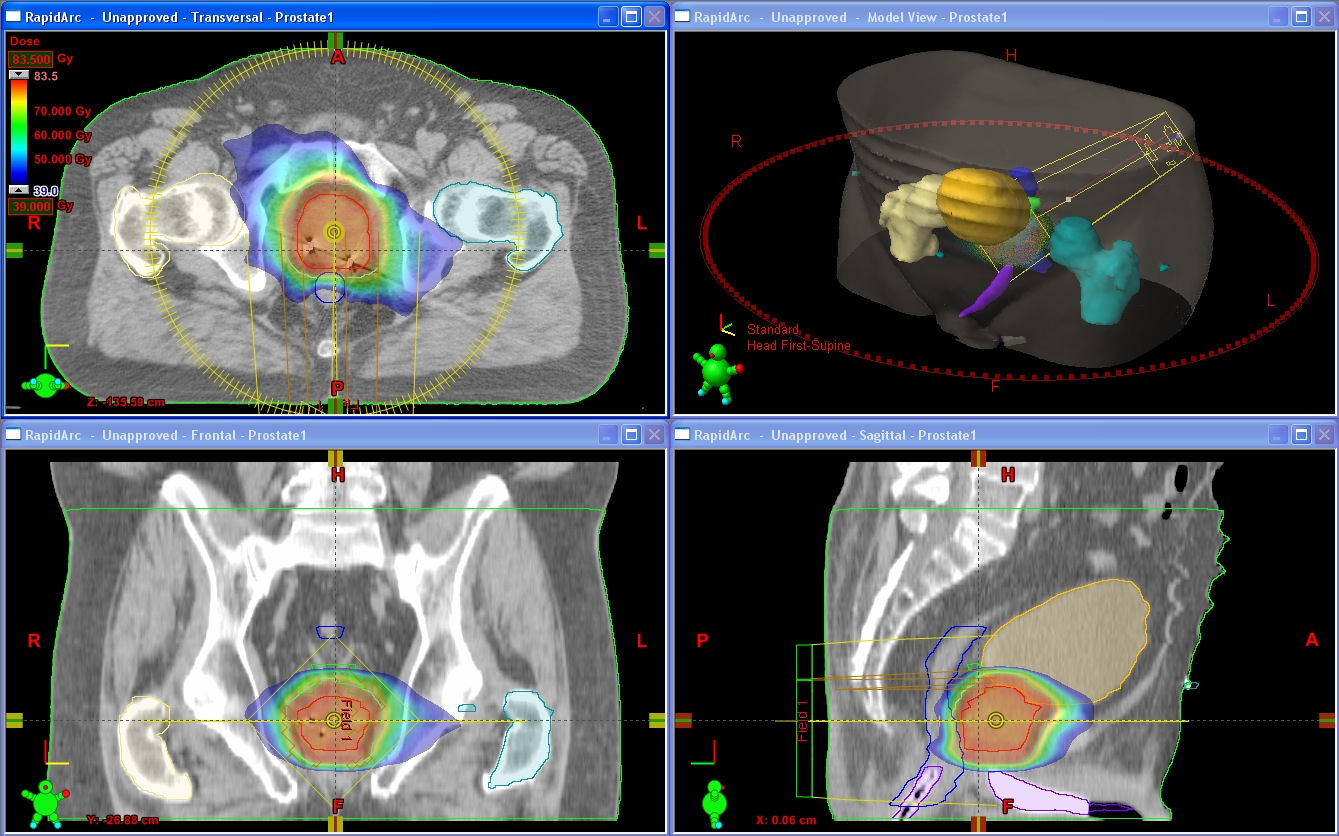 Лучевое лечение простаты. Трехмерное планирование лучевой терапии. IMRT лучевая терапия. Оконтуривание в лучевой терапии. Трехмерная конформная лучевая терапия.